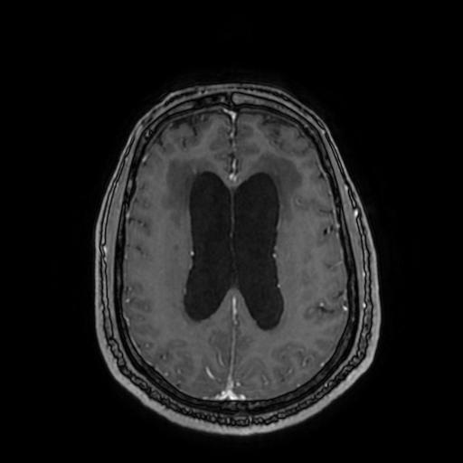 Cerebellar hemangioblastoma (Radiopaedia 88055-104622 Axial T1 C+ 116).jpg