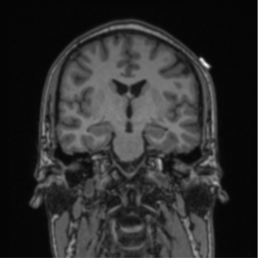 File:Cerebellar hemangioblastomas and pituitary adenoma (Radiopaedia 85490-101176 Coronal T1 49).png