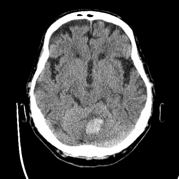 Cerebellar hemorrhage (Radiopaedia 27193-27359 Axial non-contrast 19).jpg
