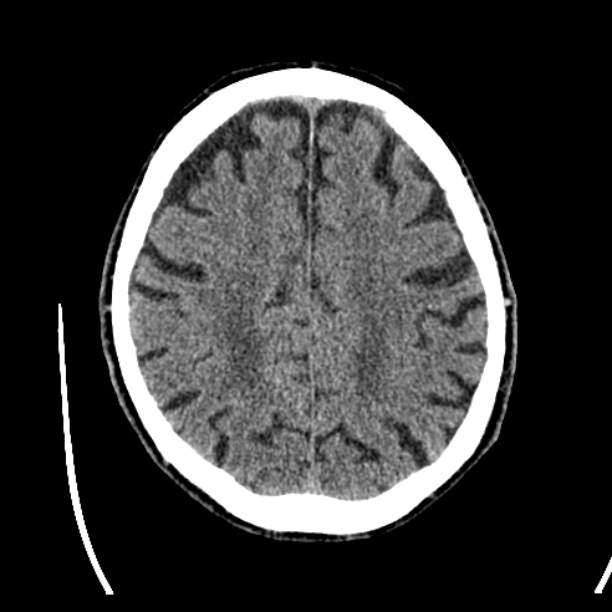 Cerebellar hemorrhage (Radiopaedia 27193-27359 Axial non-contrast 38).jpg