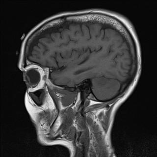 File:Cerebellar metastases (Radiopaedia 24038-24249 Sagittal T1 14).jpg