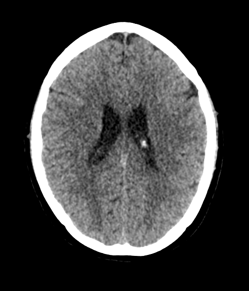 Cerebellar metastases - colorectal adenocarcinoma (Radiopaedia 40947-43652 Axial non-contrast 40).png