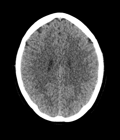 Cerebellar metastases - colorectal adenocarcinoma (Radiopaedia 40947-43652 Axial non-contrast 43).png