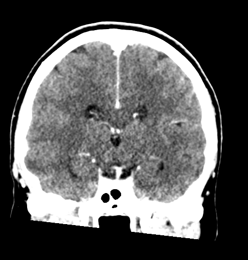 Cerebellar metastases - colorectal adenocarcinoma (Radiopaedia 40947-43652 Coronal C+ 51).png