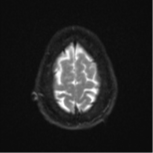 Cerebellar metastasis (Radiopaedia 51137-56765 Axial DWI 25).png