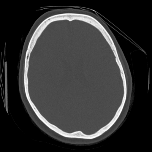 Cerebellar metastasis (cystic appearance) (Radiopaedia 41395-44258 Axial bone window 43).png