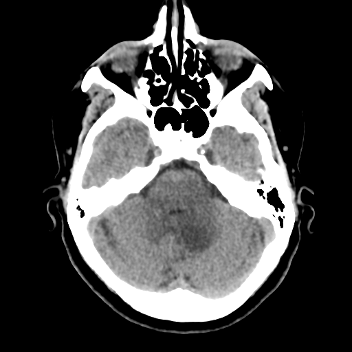 File:Cerebellar metastasis (cystic appearance) (Radiopaedia 41395-44258 Axial non-contrast 17).png