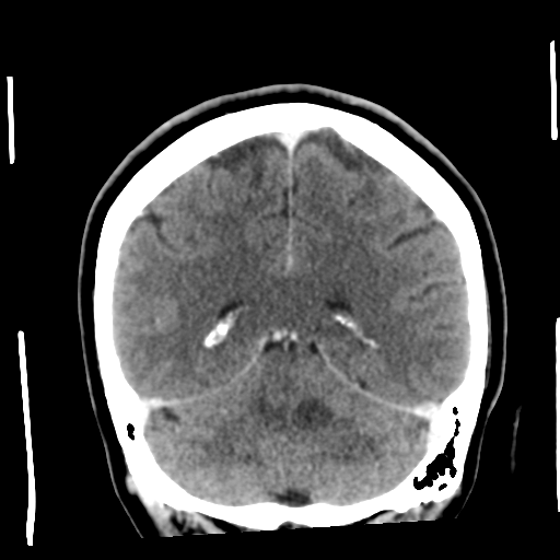 Cerebellar metastasis (cystic appearance) (Radiopaedia 41395-44258 D 43).png