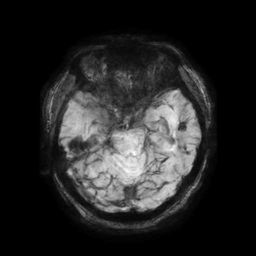 Cerebellar metastasis of pulmonary adenocarcinoma, cavernous venous malformation, and developmental venous anomaly (Radiopaedia 85827-101661 Axial SWI 46).jpg