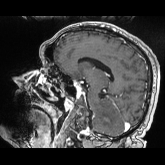 Cerebellar metastasis of pulmonary adenocarcinoma, cavernous venous malformation, and developmental venous anomaly (Radiopaedia 85827-101661 Sagittal T1 C+ 43).jpg