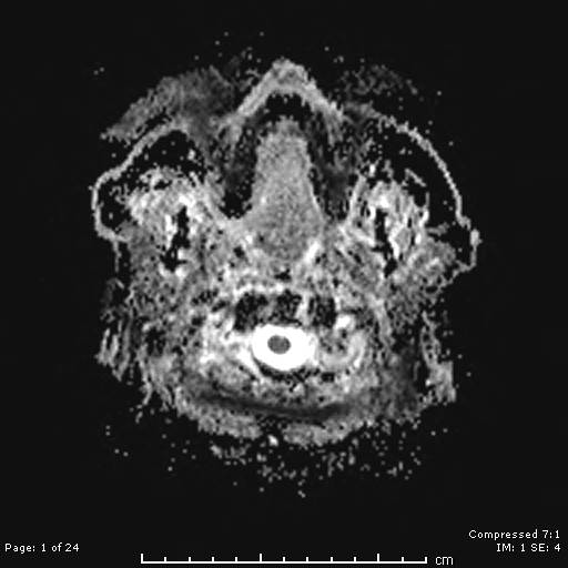 File:Cerebellar strokes due to intracranial giant cell arteritis (Radiopaedia 68799-81713 Axial ADC 1).jpg