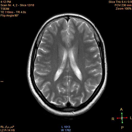 File:Cerebellopontine angle meningioma (Radiopaedia 22488-22525 Axial T2 10).jpg