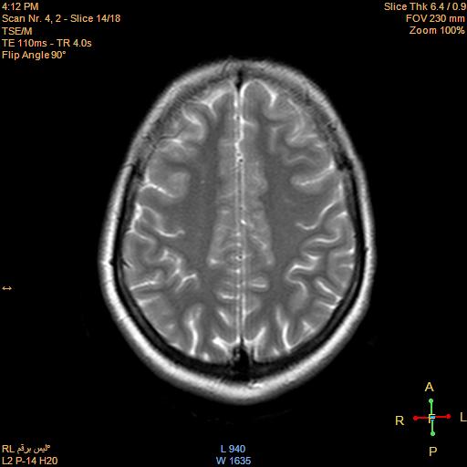 File:Cerebellopontine angle meningioma (Radiopaedia 22488-22525 Axial T2 12).jpg