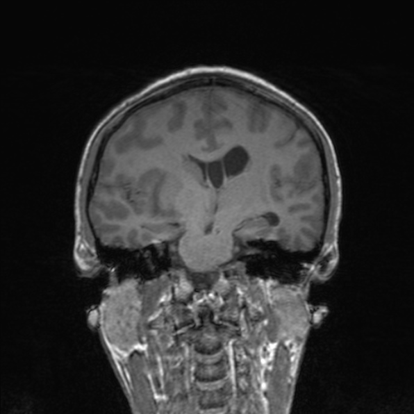 Cerebral abscess (Radiopaedia 24212-24478 Coronal T1 116).jpg