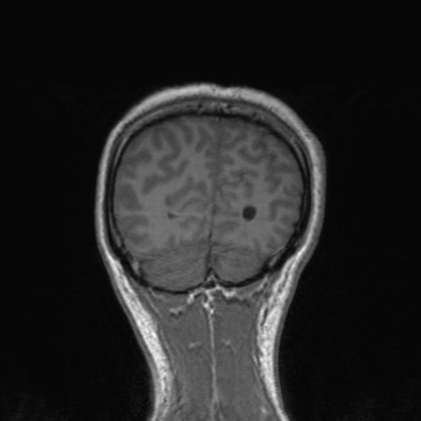 Cerebral abscess (Radiopaedia 24212-24478 Coronal T1 169).jpg