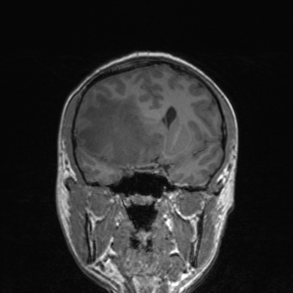 File:Cerebral abscess (Radiopaedia 24212-24478 Coronal T1 90).jpg
