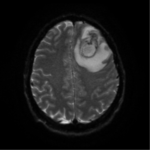 File:Cerebral abscess (Radiopaedia 57774-64740 Axial DWI 50).png