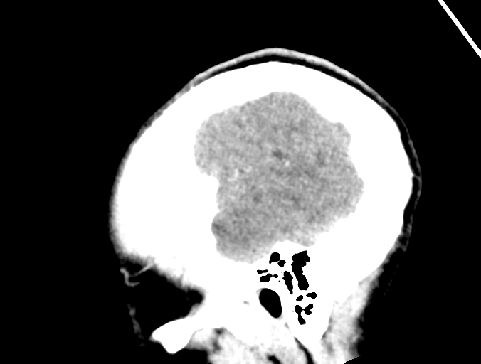 File:Cerebral abscess (Radiopaedia 60342-68008 Sagittal C+ delayed 7).png