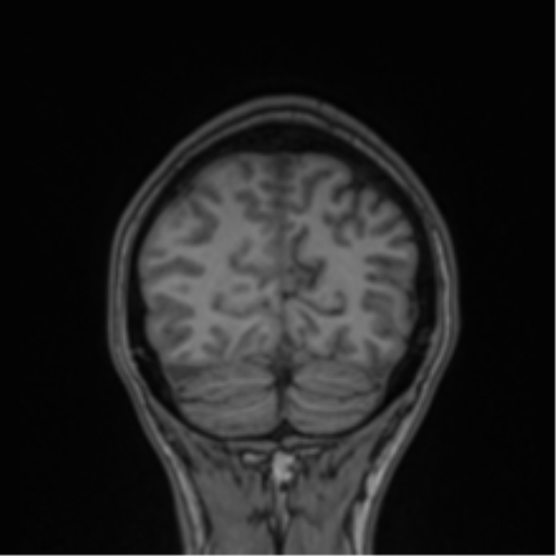 Cerebral abscess (Radiopaedia 60342-68009 Coronal T1 5).png