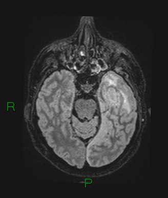 Cerebral abscess and subdural empyema (Radiopaedia 84436-99779 Axial FLAIR 56).jpg