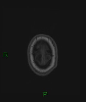 Cerebral abscess and subdural empyema (Radiopaedia 84436-99779 Axial T1 9).jpg