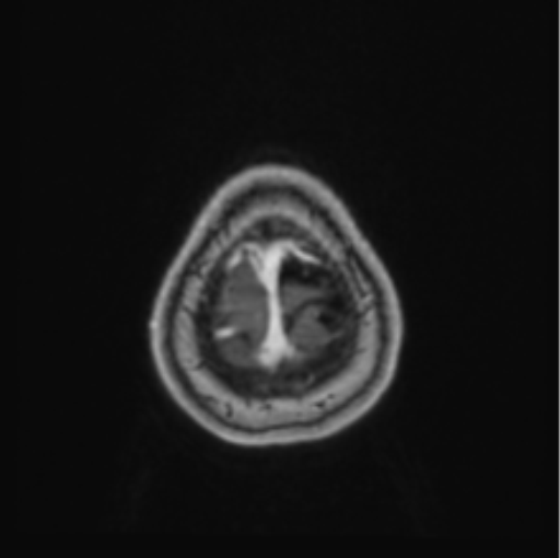 Cerebral abscess from pulmonary arteriovenous malformation (Radiopaedia 86275-102291 Axial T1 C+ 71).png
