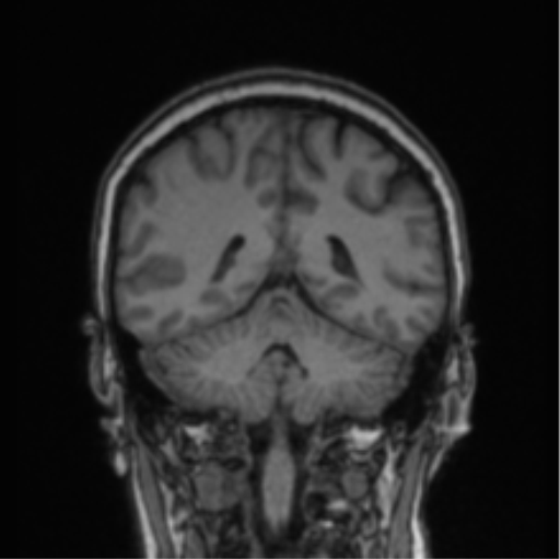 Cerebral abscess from pulmonary arteriovenous malformation (Radiopaedia 86275-102291 Coronal T1 33).png