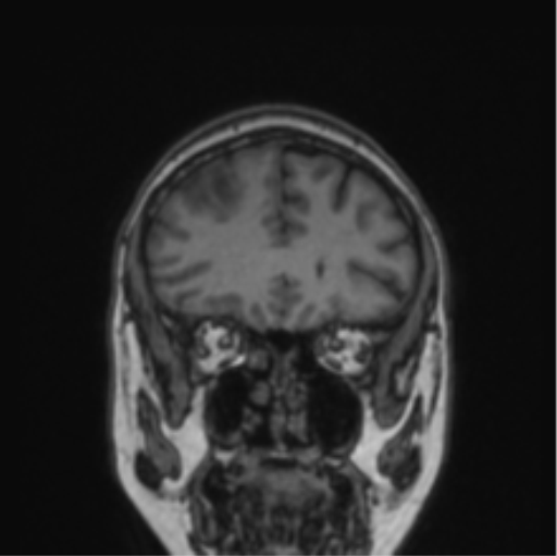 File:Cerebral abscess from pulmonary arteriovenous malformation (Radiopaedia 86275-102291 Coronal T1 67).png