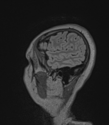 Cerebral abscess from pulmonary arteriovenous malformation (Radiopaedia 86275-102291 Sagittal FLAIR 12).png