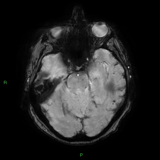File:Cerebral amyloid angiopathy-associated lobar intracerebral hemorrhage (Radiopaedia 58376-65512 Axial SWI 23).jpg