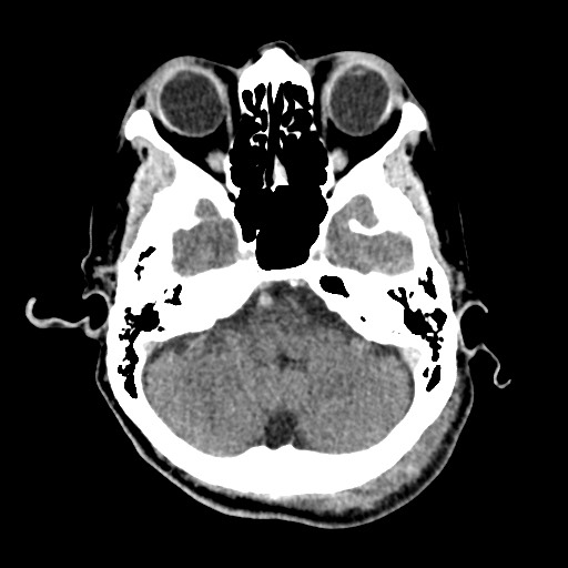 File:Cerebral amyloid angiopathy-related inflammation (Radiopaedia 74836-85848 Axial non-contrast 16).jpg