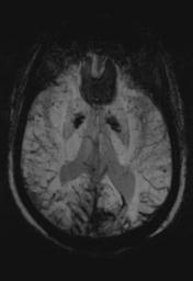 File:Cerebral amyloid angiopathy (Radiopaedia 29129-29518 Axial SWI MIP 16).jpg