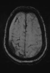 File:Cerebral amyloid angiopathy (Radiopaedia 29129-29518 Axial SWI MPR 29).jpg