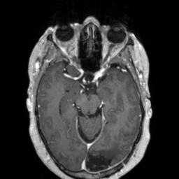 Cerebral amyloid angiopathy (Radiopaedia 29129-29518 Axial T1 C+ 59).jpg