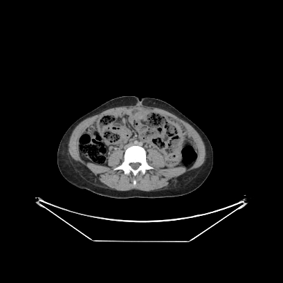 File:Cerebral and abdominal tuberculosis (PET-CT) (Radiopaedia 90499-107853 Axial 47).jpg