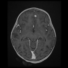 Cerebral and spinal tuberculosis (Radiopaedia 90489-107837 Axial T1 C+ 92).jpg
