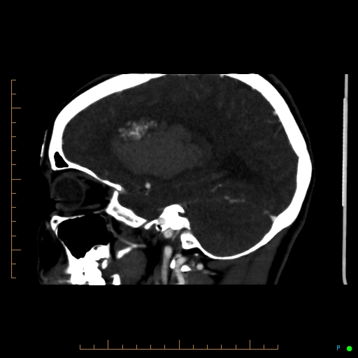 Cerebral arteriovenous malformation (AVM) (Radiopaedia 78162-90706 Sagittal CTA 28).jpg