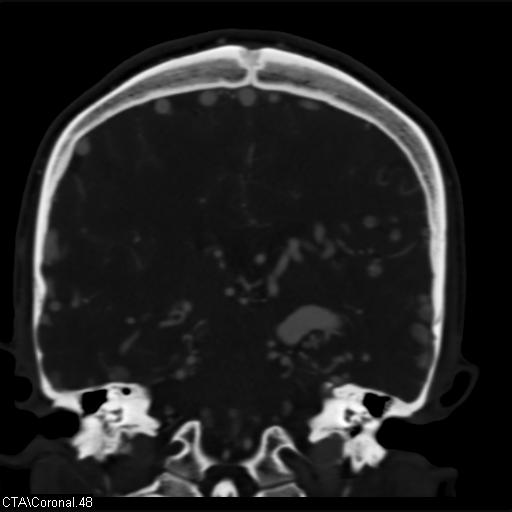 Cerebral arteriovenous malformation (Radiopaedia 28518-28759 C 48).jpg