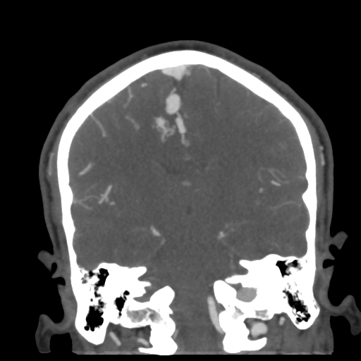 Cerebral arteriovenous malformation (Radiopaedia 39259-41505 E 39).png
