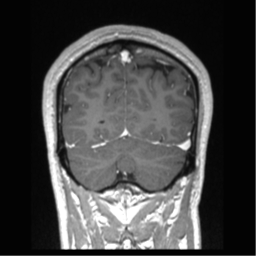 Cerebral arteriovenous malformation (Radiopaedia 39259-41506 Coronal T1 C+ 22).png
