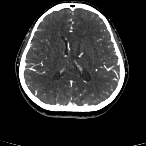 Cerebral arteriovenous malformation (Radiopaedia 73830-84645 Axial C+ delayed 39).jpg