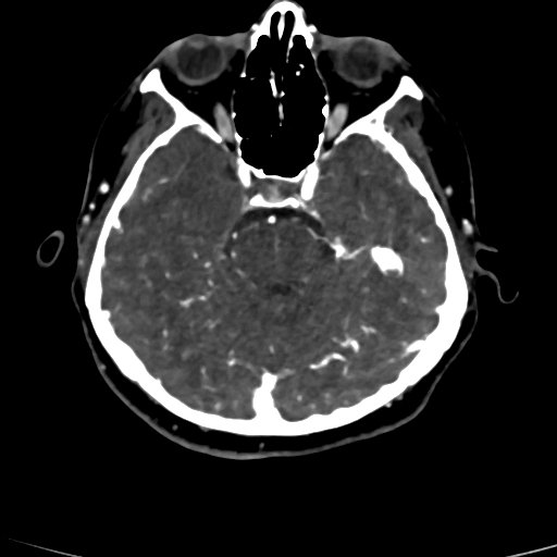 Cerebral arteriovenous malformation (Radiopaedia 73830-84645 Axial C+ delayed 64).jpg