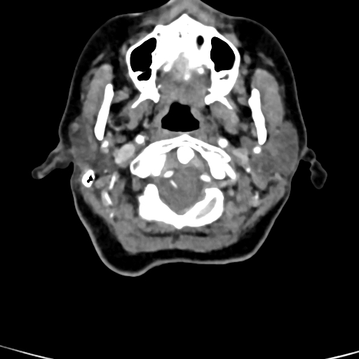 Cerebral arteriovenous malformation (Radiopaedia 73830-84645 B 94).jpg