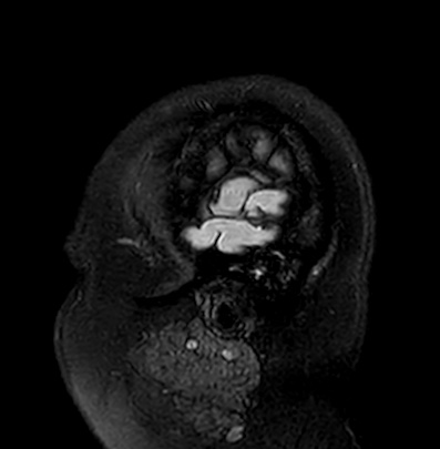 Cerebral arteriovenous malformation (Radiopaedia 74411-85746 Sagittal FLAIR 3).jpg