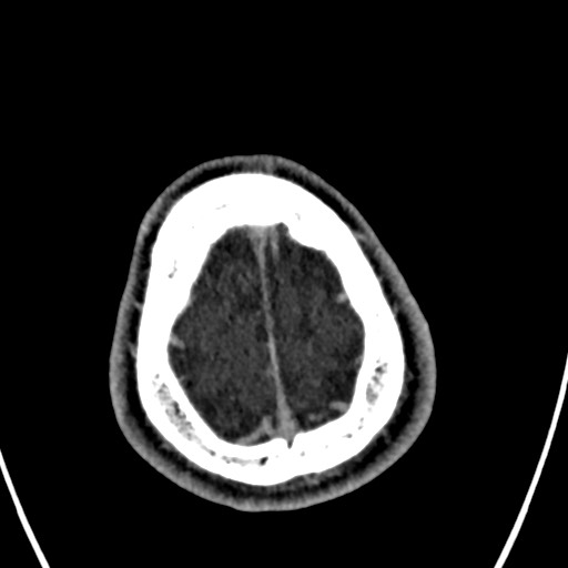 Cerebral arteriovenous malformation (Radiopaedia 78188-90746 Axial C+ delayed 157).jpg