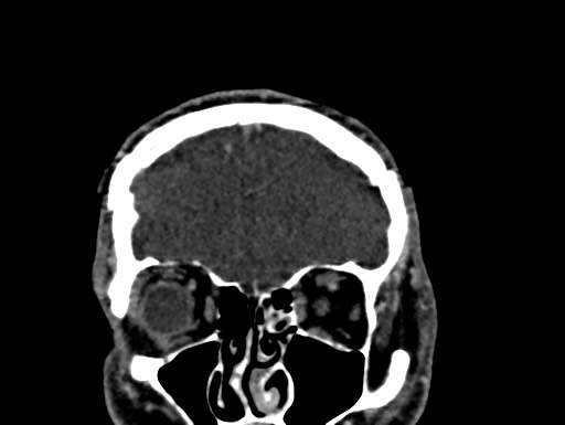 Cerebral arteriovenous malformation (Radiopaedia 78188-90746 Coronal C+ delayed 14).jpg