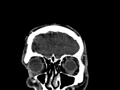 Cerebral arteriovenous malformation (Radiopaedia 78188-90746 Coronal C+ delayed 7).jpg