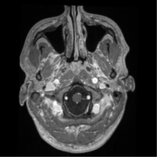 Cerebral arteriovenous malformation - huge (Radiopaedia 35734-37272 Axial T1 C+ 4).png