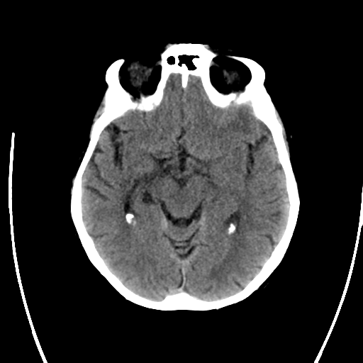 File:Cerebral arteriovenous malformation with lobar hemorrhage (Radiopaedia 44725-48512 Axial non-contrast 17).png