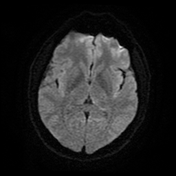 Cerebral cavernous venous malformation (Zabramski type II) (Radiopaedia 85511-101198 Axial DWI 17).jpg